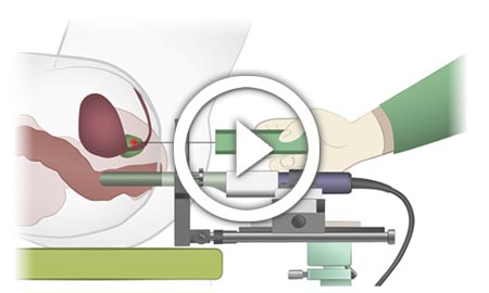 Fusionsbiopsie bei Prostatakrebs Diagnose